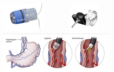 Ki sa ki EVL (endoskopik Esophageal Varix Ligation)?